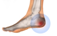 What Is a Bruised Heel?
