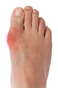 Painful Gout and What May Cause It
