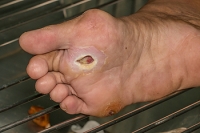 Diabetic Patients and Foot Ulcers